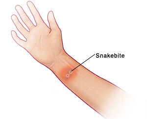 Signs and Symptoms of Snake Bites