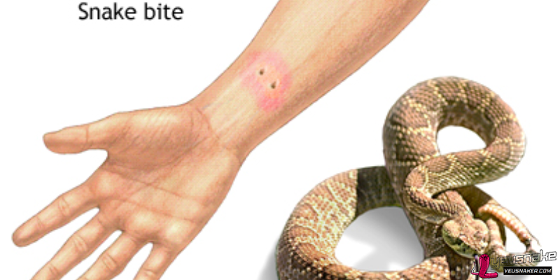 First Aid for Snake Bites